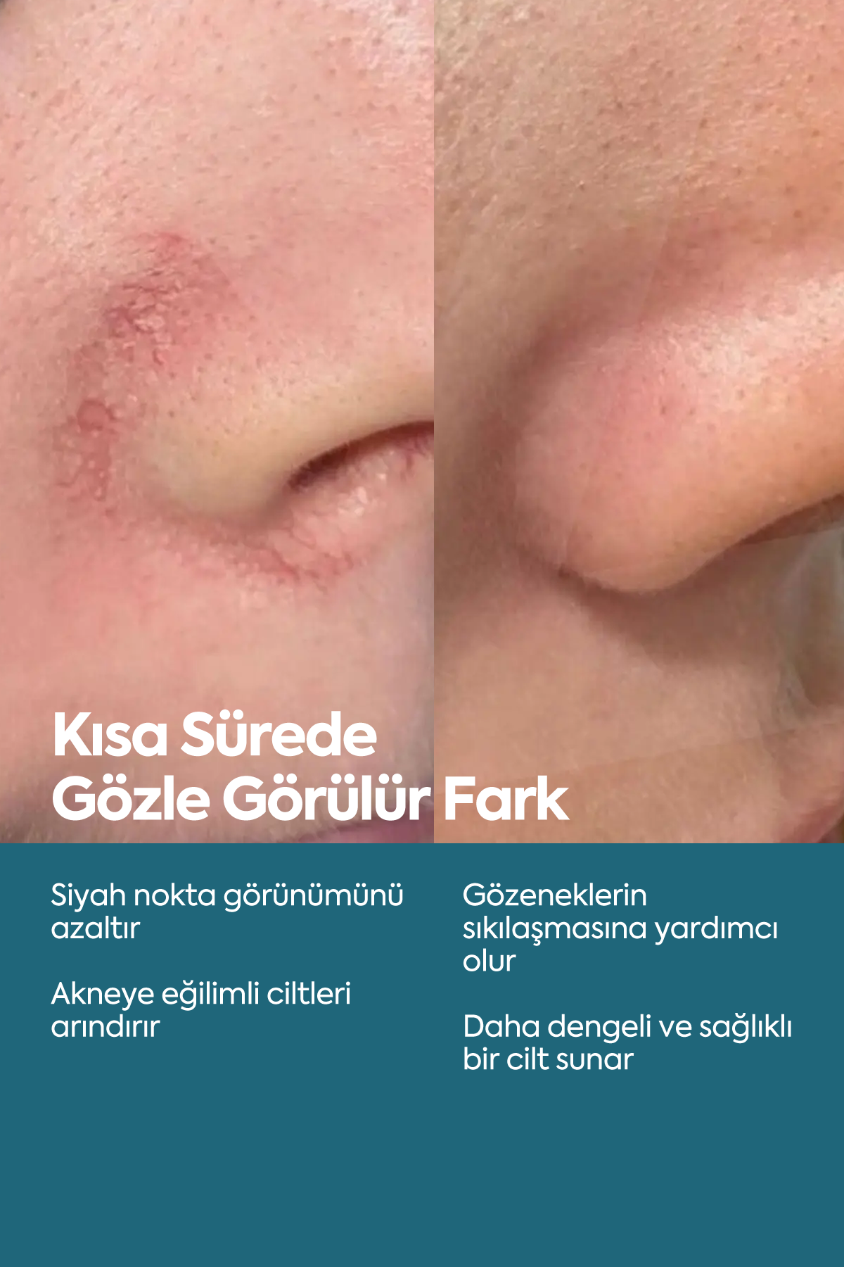 Anti Blackhead & Acne Serum — Сыворотка против чёрных точек и акне 50 мл