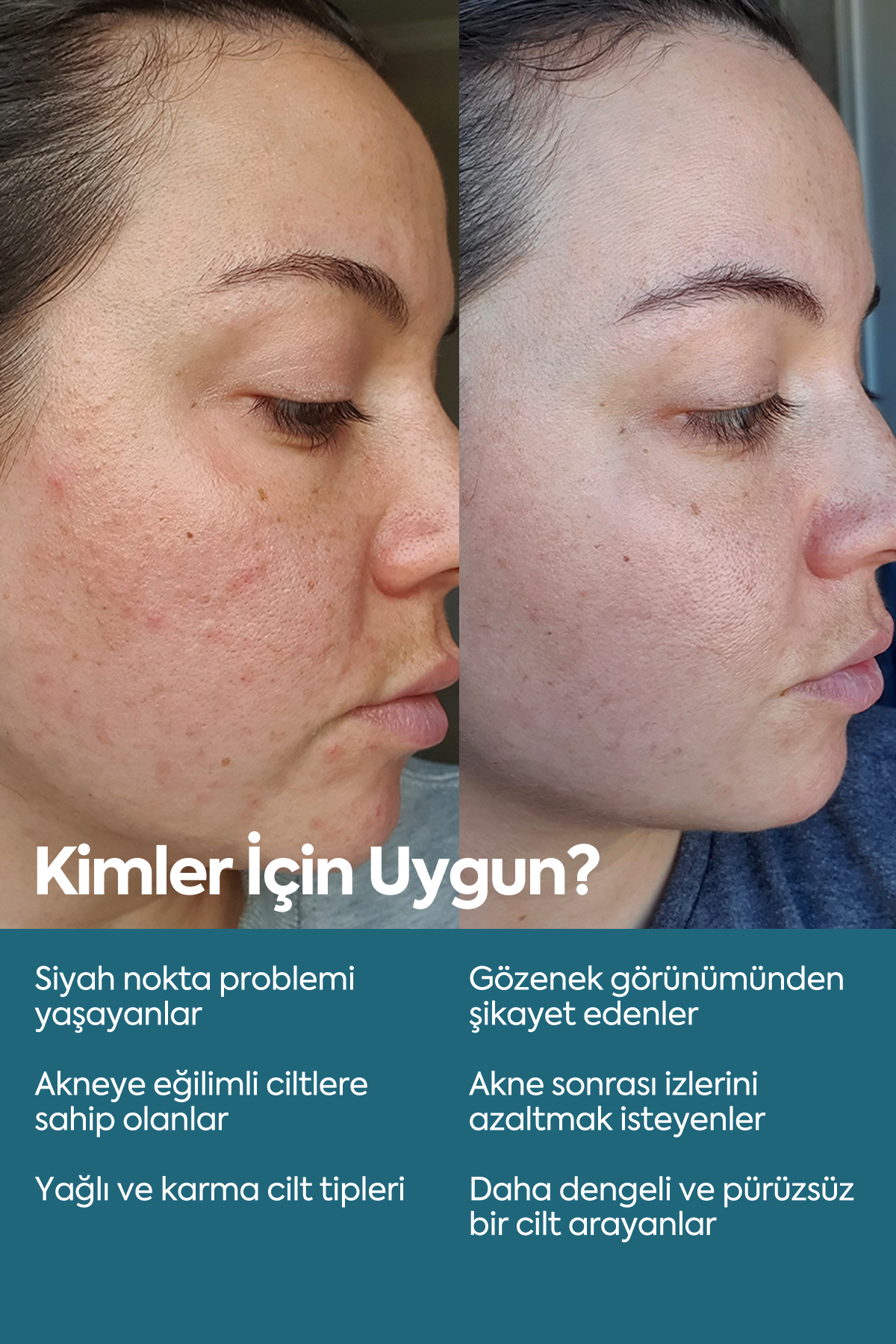 Anti Blackhead & Acne Serum — Сыворотка против чёрных точек и акне 50 мл