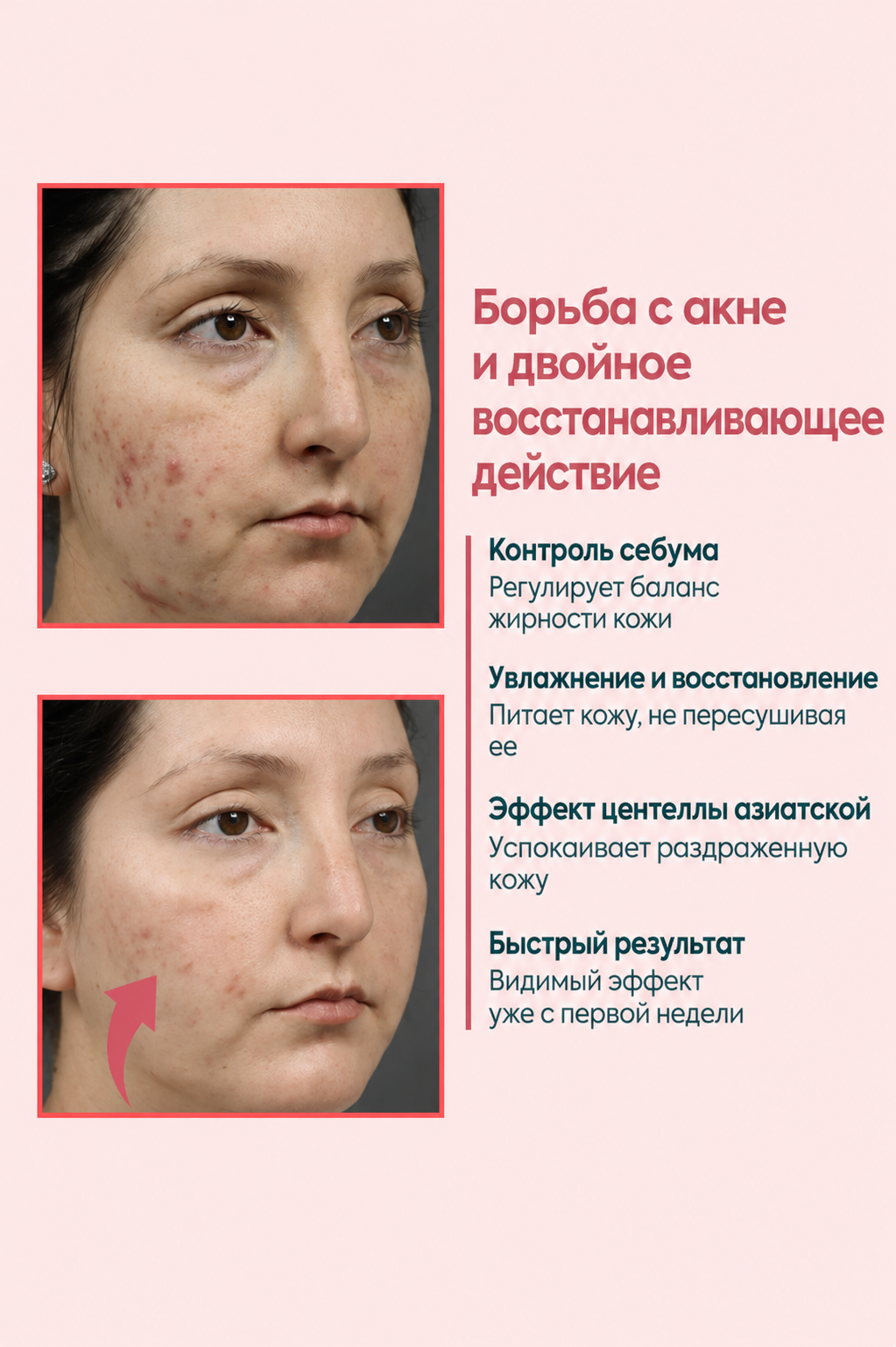 FACEUPSKIN® Acne Cream — Крем против акне и прыщей 40 мл